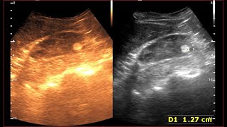 Angiomyolipoma kidney  Benign Renal Masses  Kidney Tumor [upl. by Hetty]