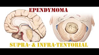 Ependymoma  Supra amp InfraTentorial [upl. by Aneladgam]