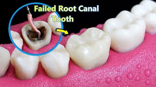 INCREDIBLE Reconstruction Of PoorFailed Root Canal Treated Tooth [upl. by Neelloc3]