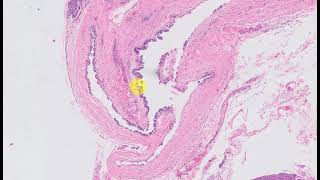 Acinar cell cystadenoma  Acinar cystic transformation of Pancreas [upl. by Emsoc733]