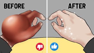 ASMR Animation Remove the big pus from the students hand  Treatment animation [upl. by Eldnik]