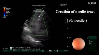 EBUS Intranodal cryobiopsy  Mediastenal Carcinoid tumor [upl. by Eicats]