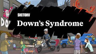 Downs Syndrome Part 1  Sketchy Medical  USMLE Step 1 [upl. by Eilime]