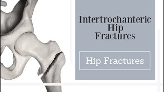 Intertrochanteric hip fractures [upl. by Lefty889]