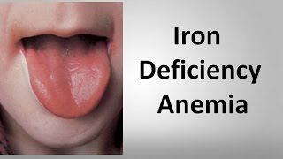 Iron Deficiency Anemia [upl. by Brody]