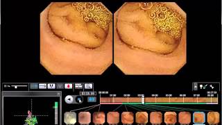 WEO Video Capsule Endoscopy VCE Library clinical case 34 [upl. by Adnerb]