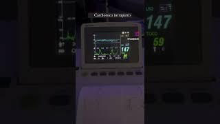 Cardiotoco intraparto Todas gestantes terão que fazer sinaisvitais [upl. by Uaeb]