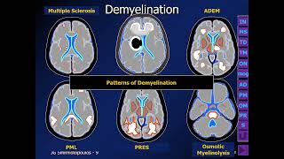 ⚕️ Making Sense of White Matter Disease by James G Smirniotopoulos MD [upl. by Dlarej]