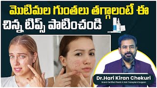 How to Get Rid Acne Scars on Face  Best Treatment for Acne Scars  ReDefine Channel [upl. by Anatollo856]