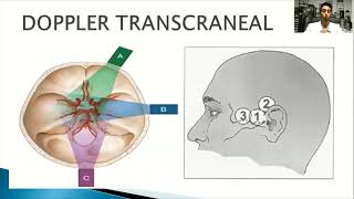 Doppler transcraneal 2 [upl. by Arikahs334]