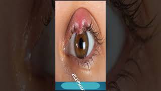 Blepharitis Treatment  Which Medicine Use In Blepharitis [upl. by Yecats]