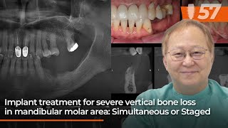 Implant treatment for severe vertical bone loss in mandibular molar area Simultaneous or Staged [upl. by Sirah]