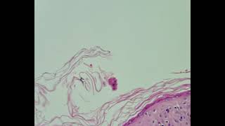 Histopathology of Lupus erythematosus [upl. by Nyrok551]