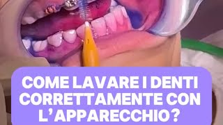 Come lavare i denti correttamente con l’apparecchio [upl. by Bainter]