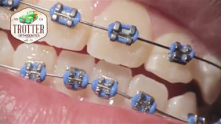 Watch How Braces Are Put On  Orthodontic Treatment Using Fixed Brackets Redondo Beach Orthodontist [upl. by Ellenrahc]