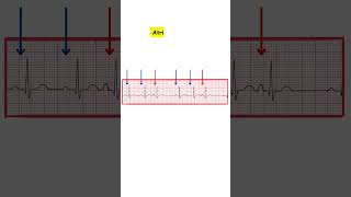 Atrial Trigeminy ecg ecginterpretation medicine doctor cardiology medicalstudent nurse [upl. by Tuhn11]