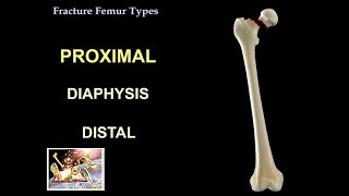 Fracture Femur Types  Everything You Need To Know  Dr Nabil Ebraheim [upl. by Retrop]