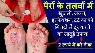 पैर के तलवे में खुजली क्यों होती है तलवे में खुजली कैसे ठीक करें  Itching in the feet [upl. by Rovert747]