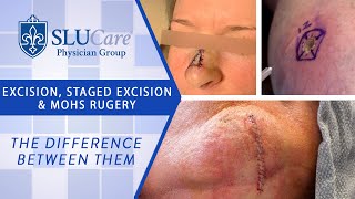 The Difference Between Excision Staged Excision amp Mohs Surgery for removing skin cancer [upl. by Arihday]