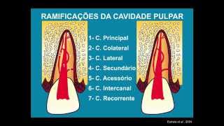 Abertura Coronária e Preparo do Canal Radicular [upl. by Keene]