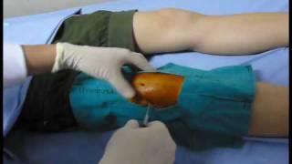 Knee aspiration technique Knee synovitis เจาะเข่า เข่าอักเสบ [upl. by Eam]