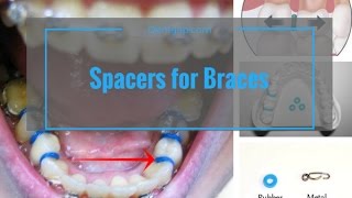 Spacer For Braces  Do They Hurt  Check Live View [upl. by Julee602]