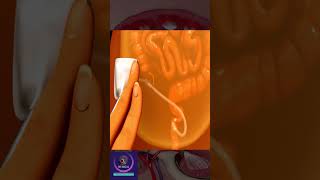 Peritoneal Dialysis  Short Medical Animation [upl. by Moretta589]