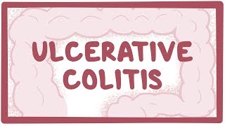 Ulcerative colitis  causes symptoms diagnosis treatment pathology [upl. by Sirrah731]