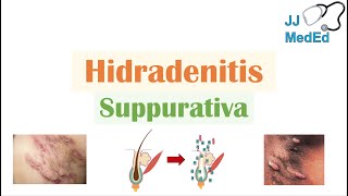 Hidradenitis Suppurativa HS  Pathophysiology Triggers Signs amp Symptoms Diagnosis Treatment [upl. by Portwine]