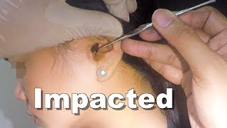 Girls Impacted Earwax Finally Removed After 5 Days of Earwax Softener [upl. by Illa]