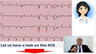 EKG Trainer Case 3 Answer [upl. by Aneerehs]