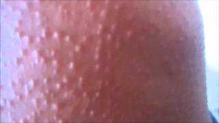 Miliaria Rash Quick Treatment [upl. by Annaoj]