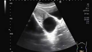 Ultrasound Video showing an large Ovarian Cyst [upl. by Yoho]