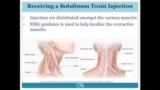 Treatment of Cervical Dystonia [upl. by Peadar103]