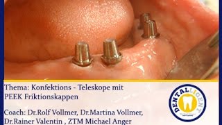 Zahntechnik  FREE VIDEO  KonfektionsTeleskope mit PEEK Friktionskappen [upl. by Giles]