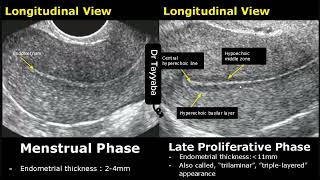 Endometrial Thickness Ultrasound Image Appearances  Endometrium Menstrual Cycle USG Images [upl. by Capwell]