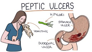 Understanding Stomach and Duodenal Ulcers [upl. by Anahgem]