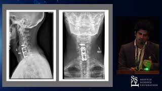 Mobi c failures in cervical arthroplasty patients Varun Yadav MD [upl. by Selene]