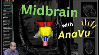 Overview of Midbrain  with AnaVU developed by IIITH with radiology input from SCTIMST [upl. by Wendell]