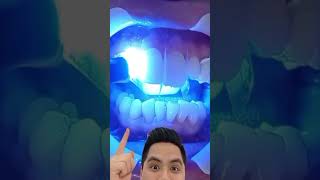 Carillas dentales de resina es tu mejor opción dientes dentista tips parati viral fyp [upl. by Sneve]