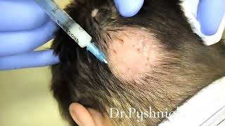 Intralesional corticosteroid injections for alopecia areata [upl. by Echo]