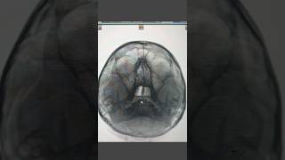 Xray PNS sinusitis anatomy radiologist medicaltest radiologycareer doctor radiology xray [upl. by Aleedis]