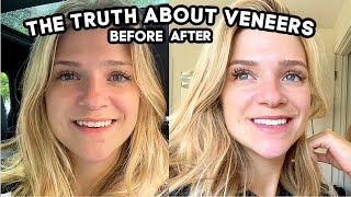 What They Dont Tell You About Getting Veneers Pain Cost Is It Worth it [upl. by Anyala]