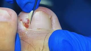 You Wont Believe This Huge Ingrown Toenail Removal [upl. by Ahsam928]