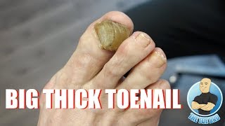 HOW TO TREAT YOUR BIG THICK RAMS HORN TOENAIL  FOOT HEALTH MONTH 2018 14 [upl. by Fenton]