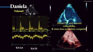 Diastolic dysfunction amp the PW Doppler for assessing volume status with ultrasound 〖Ultrasound〗 💘 💫 [upl. by Berlauda]