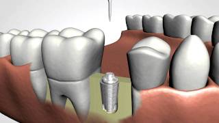 Dental Implants [upl. by Genevra]