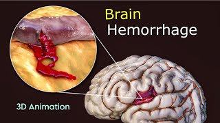 What Triggers Brain Hemorrhage  3D Animation  Scopic Vision [upl. by Herstein]