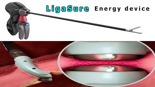 Ligasure  Bipolar energy device [upl. by Lemahs748]