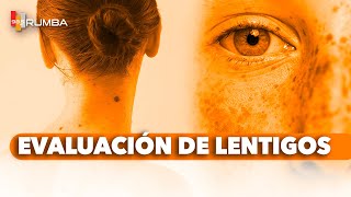 quotRevisión de Lentigos ¿Es Solo un Lentigoquot [upl. by Nabatse]